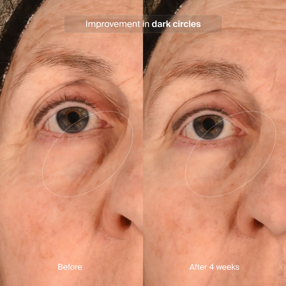 PRECISION EYE LIFT